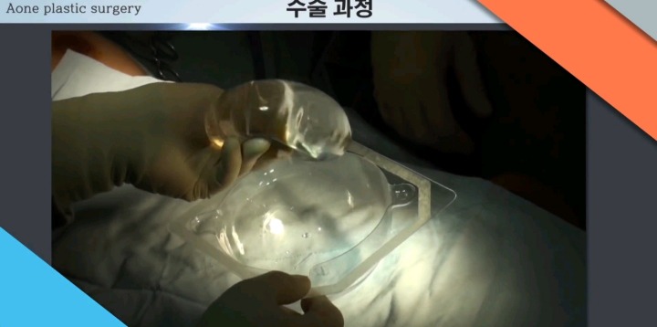 보형물 이용한 가슴성형.jpg (사진주의) | 인스티즈